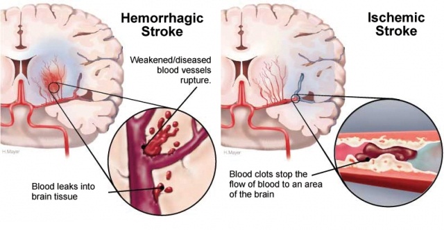 recognize-the-symptoms-of-a-stroke-before-it-happens-healthy-food-advice