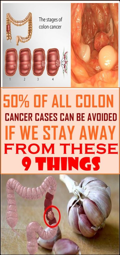 50% Of All Colon Cancer Cases Can Be Avoided If We Stay Away From These 