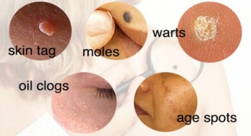 A Complete Guide To Removing Warts, Moles, Skin Tags and