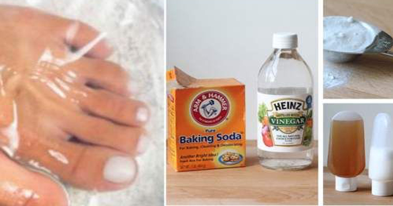 2 Ingredient Natural Remedy To Get Rid Of Nail Fungus Fast And Forever 