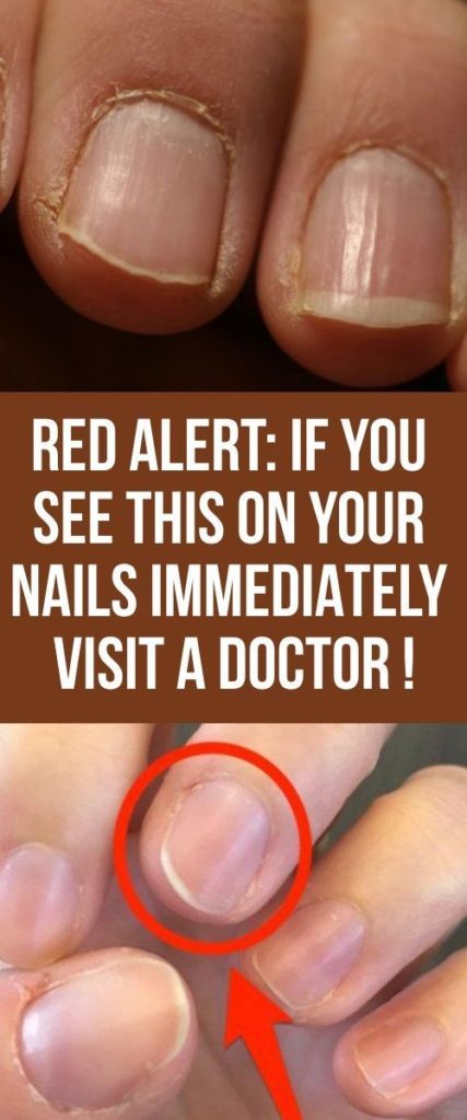 RED ALERT: IF YOU SEE THIS ON YOUR NAILS, VISIT A DOCTOR IMMEDIATELY ...