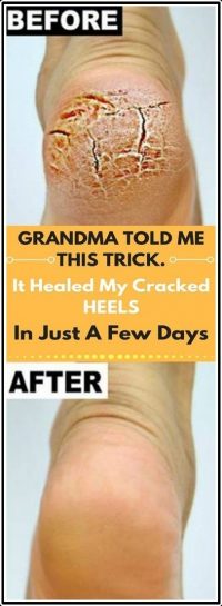 Grandma Told Me This Trick It Healed My Cracked Heels In Just 1 Night